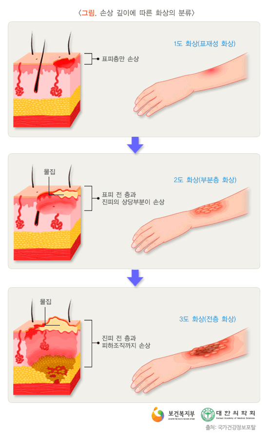 손상 깊이에 따른 화상의 분류