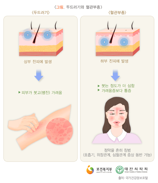 Treatment of urticaria, tingling, yokchon, yokchon, and oriental medicine