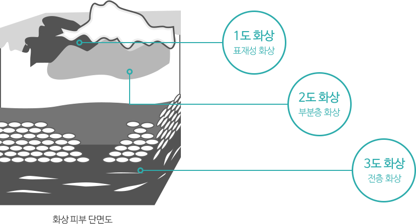 화상 피부 단면도