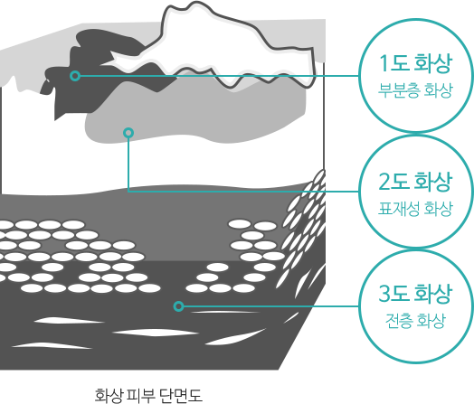 화상 피부 단면도