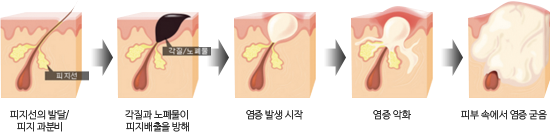 여드름 발생 과정